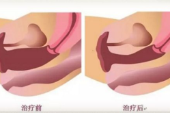 私密紧致是怎么做呢,轻松恢复紧致，重拾自信之美